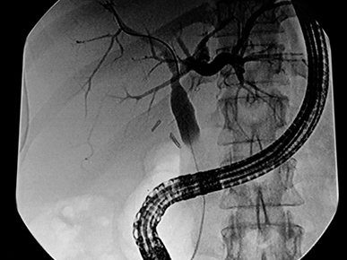 Complex ERCP Cases: What to Expect When You Refer