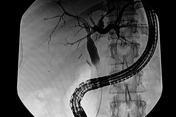 Complex ERCP Cases: What to Expect When You Refer